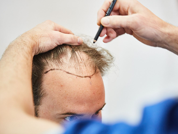 Boek nu jouw haartransplantatie tegen gereduceerd tarief bij onze Transhair Academy