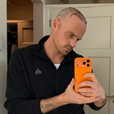 Giel de Winter eerlijk over onzekerheid en nieuwe haartransplantatie: 