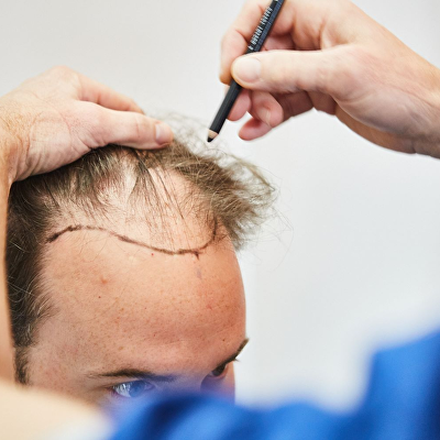 Zo kies je de beste haartransplantatiekliniek in Nederland