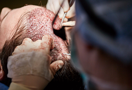 Genezing na de haartransplantatie