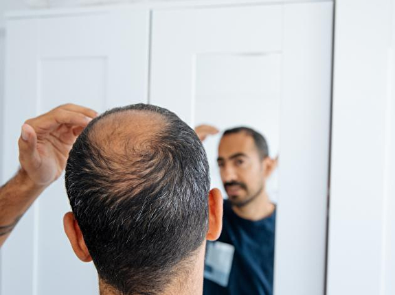 Teveel grafts bij een Turkse haartransplantatie