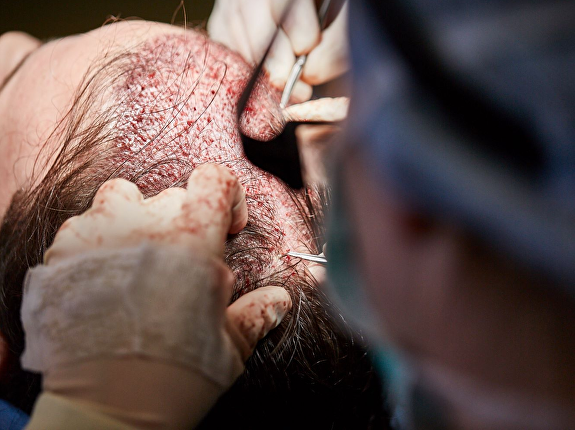 Haartransplantatie kaalheid mannen
