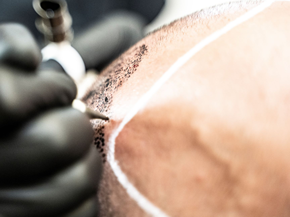 4. Hoe lang duurt een MHP-behandeling?