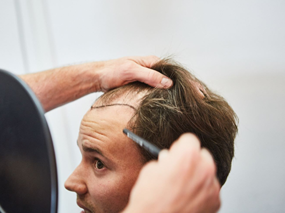 5. Kan MHP ook gebruikt worden om een litteken te camoufleren?