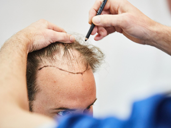 De belastingdienst en haartransplantaties