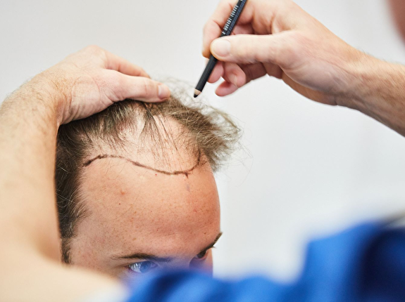 Behandelwijze haarimplantaat