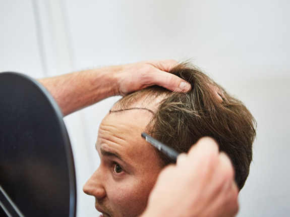 Hoeveel haarimplantaten?