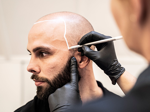 Wat zijn de verschillen tussen haaruitval bij de inhammen bij vrouwen en mannen?