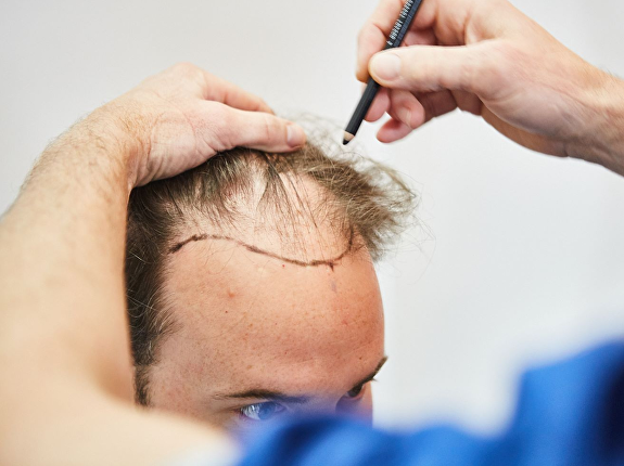 Ga haaruitval bij je inhammen tegen met professionele haartransplantatie bij Transhair! 