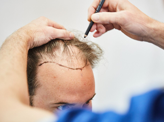 Haarverlies heeft impact op jouw zelfbeeld