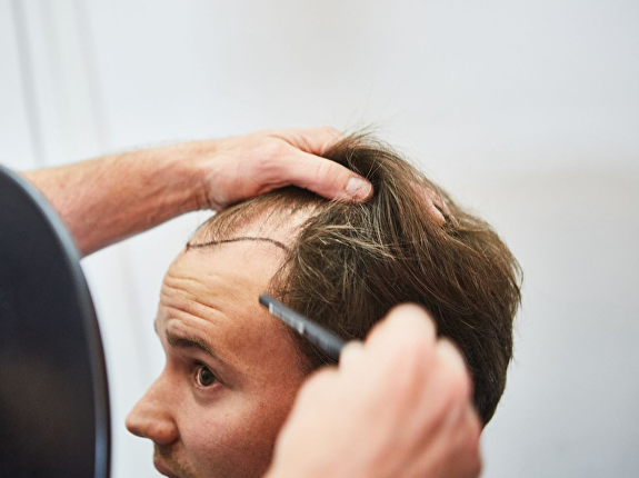 Wat is het verschil tussen Micro FUE en FUE?