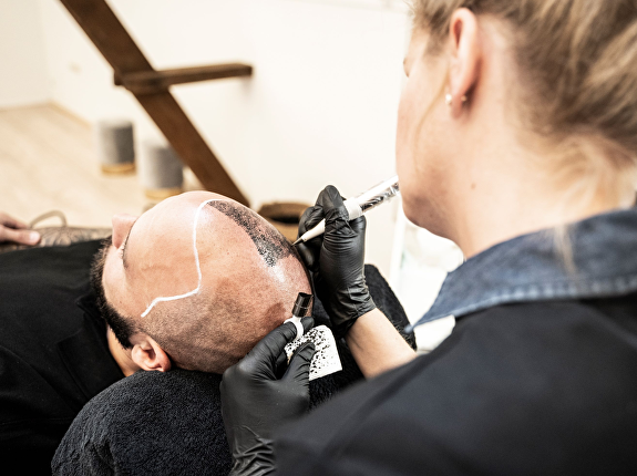 Voor wie is Micro FUE geschikt?