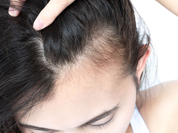 Vrouwen met een hoge haargrens: haartransplantatie
