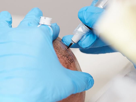 Wat gebeurt er daarna met de FUE grafts?