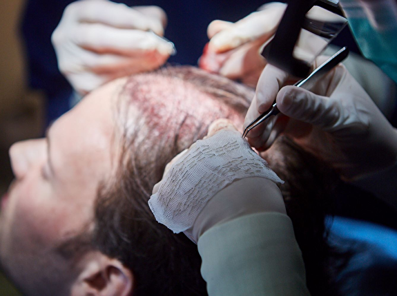 Voor- en nadelen FUE-haarimplantatie