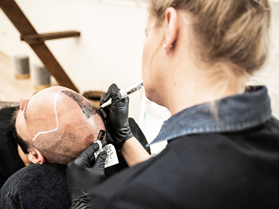 Waarom opnieuw een haartransplantatie?