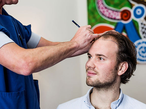 Waarop letten bij volgende haartransplantatie?