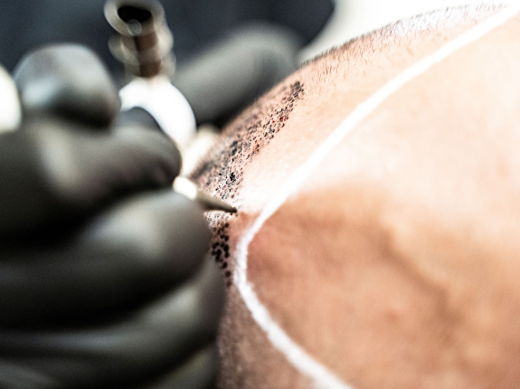 Waarom microhaarpigmentatie?