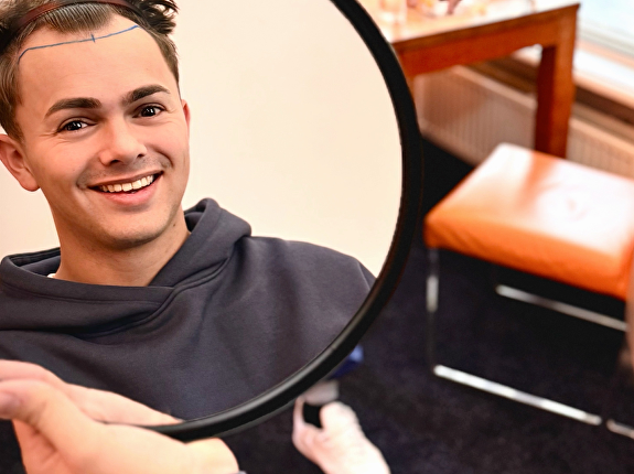 Voor en na de haartransplantatie