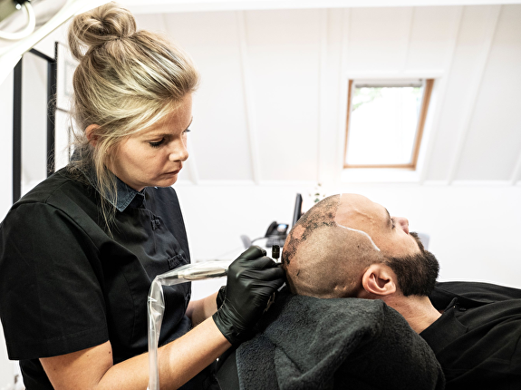 De voordelen van een haartransplantatie bij Transhair