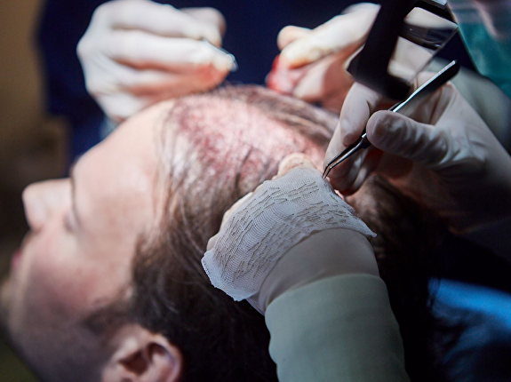 De FUE-haartransplantatie