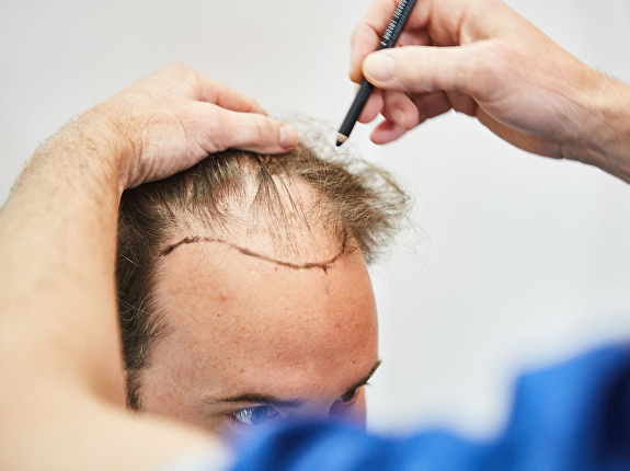 Voor de FUE-behandeling